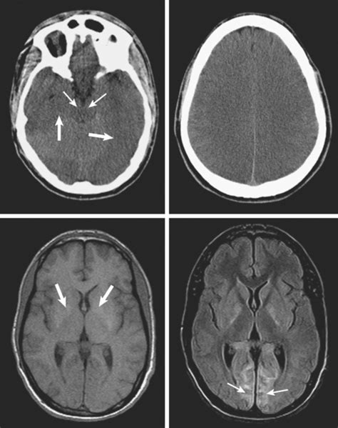 Hypoxic-Ischemic Brain Damage | Radiology Key