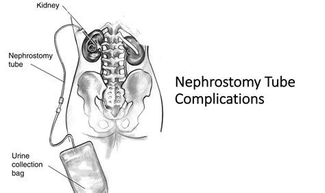 Nephrostomy Tube