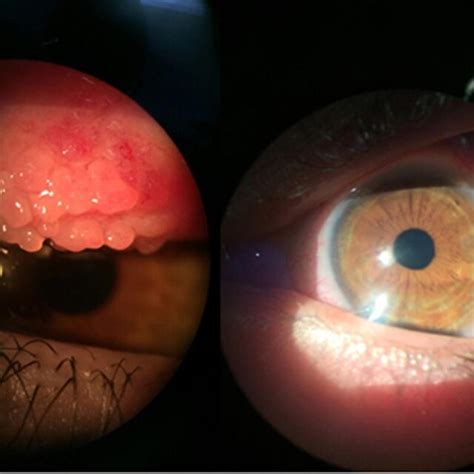 Vernal keratoconjunctivitis (VKC) corneal alterations as observed with ...