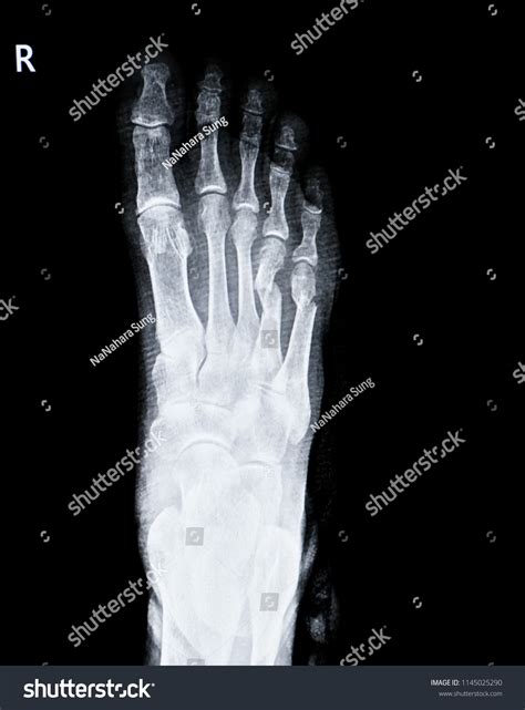 Xray Right Foot Show Fracture Bone Stock Photo 1145025290 | Shutterstock