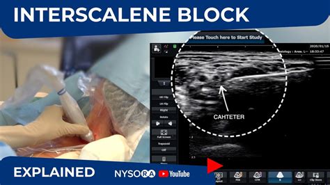 Ultrasound-Guided Continuous Interscalene Block - Regional anesthesia Crash course with Dr ...