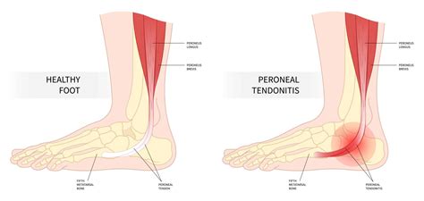 Peroneal Tendonitis And Tendinopathy Causes Symptoms Treatment And ...