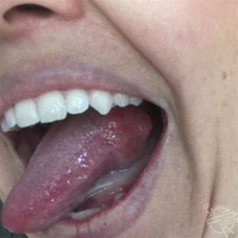 This Mum Had A Shock When A Bump On Her Tongue Ended Up Being Cancer | Media Drum World