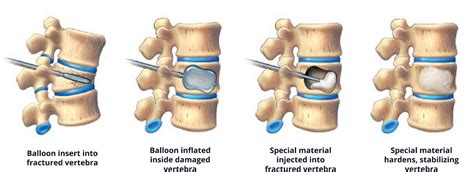 Kyphoplasty and Sacroplasty for Compression Fractures- Back Pain Treatment