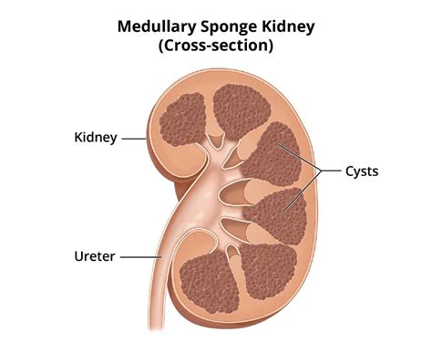 Medullary Cystic Disease