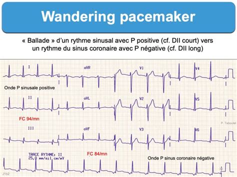 Wandering pacemaker : e-cardiogram