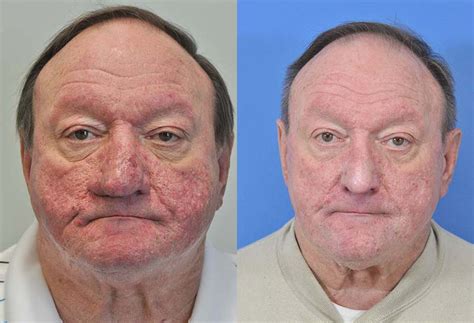 Rosecea & Rhinophyma Before & After | Savannah Facial Plastic Surgery