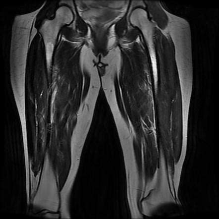 Dermatofibrosarcoma protuberans - recurrence | Image | Radiopaedia.org