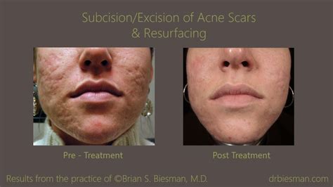 Acne Scar Treatment - Brian Biesman MD | Nashville, TN