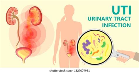 839 Urine Obstruction Images, Stock Photos, 3D objects, & Vectors | Shutterstock