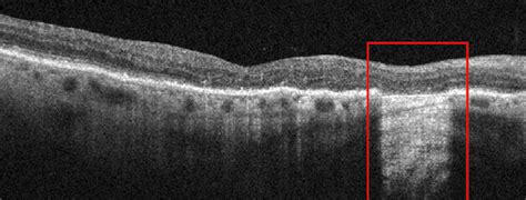 Thinned Outer Retinal Layer May Predict Faster Geographic Atrophy Growth