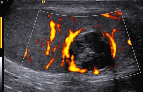 testicular epidermoid | pacs