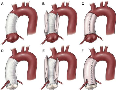 (A) Supracoronary ascending aortic graft replacement. (B) Bovine ...