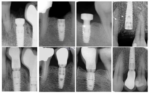 Materials | Free Full-Text | Factors Affecting Implant Failure and ...