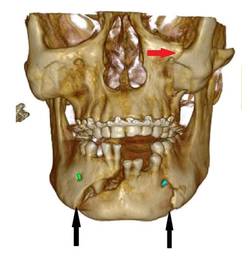 Maxillofacial trauma imaging using CBCT