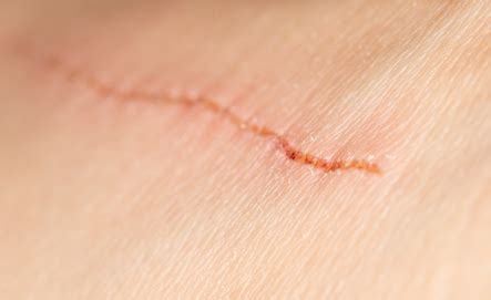 The Wound Healing Process | WoundSource