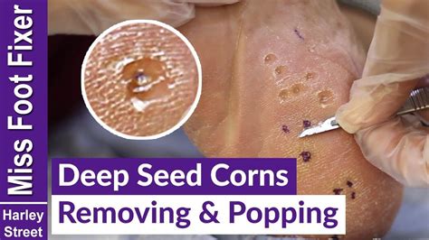 DEEP SEED CORNS REMOVING AND POPPING BY MISS FOOT FIXER MARION YAU | Corn seed, Corn removal ...