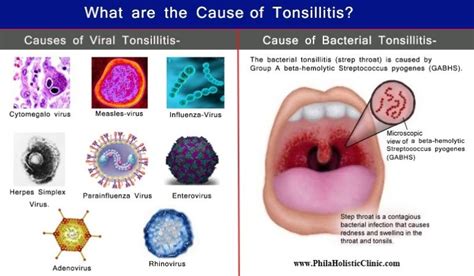 Treatment of Tonsillitis - Philadelphia Holistic Clinic - Dr. Tsan & Associates