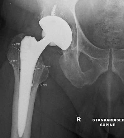 Aseptic loosening of hip joint replacements | Radiology Reference ...