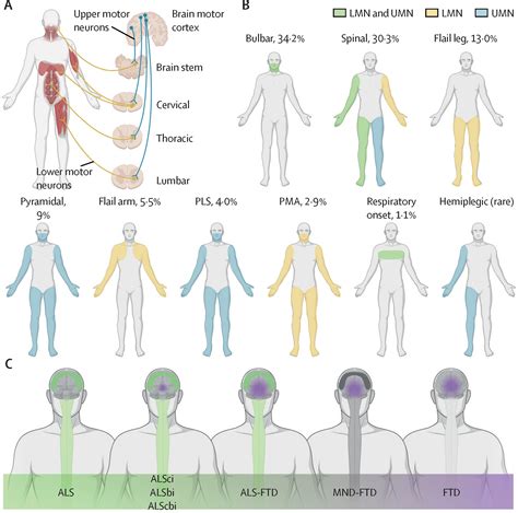 Amyotrophic lateral sclerosis - The Lancet