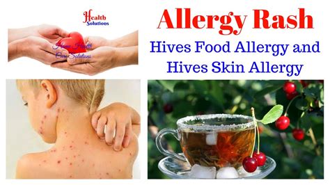 Allergy Rash - Hives Food Allergy and Hives Skin Allergy - YouTube