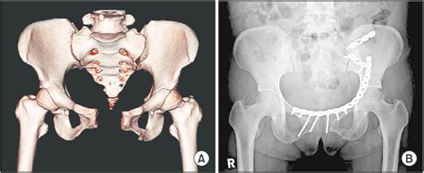 (A) Unstable pelvic ring injury in a 43-year-old female. (B) Stable... | Download Scientific Diagram