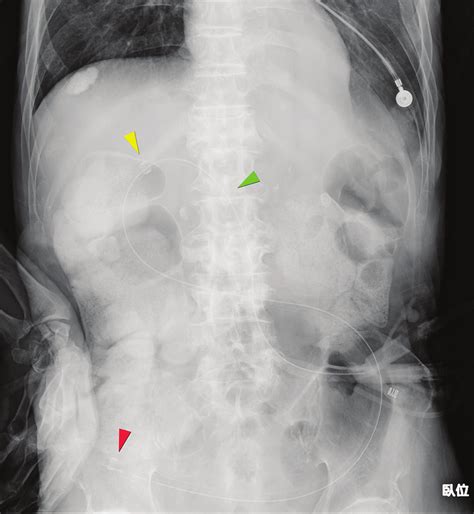 Abdominal X-ray taken after PEG-J tube placement. | Download Scientific Diagram