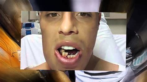 Rugby league player suffers 'worst broken jaw injury' doctors have ever seen in shocking - YouTube