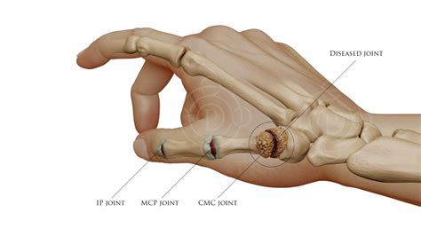 West Palm Beach Thumb Arthritis Surgery, Treatment, Symptoms | Wellington