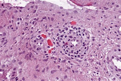 Russell Bodies & Germinal Centers Scoring Imaging | HSS