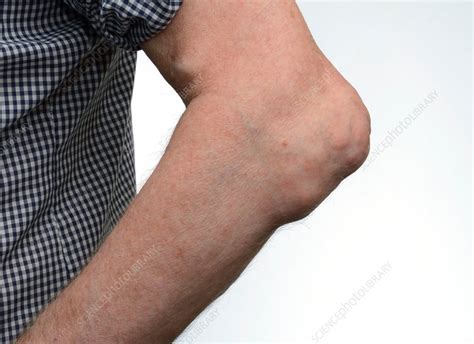 Gout tophi in the elbow - Stock Image C014/2460 - Science Photo Library