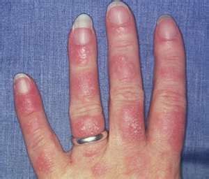 Lupus Hand - Yes, that's how they look | Lupus, Lupus hands, Lupus rash