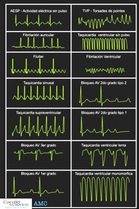 Electrocardiograma Ecg Ecg Con Arritmia Cardiaca Imagen De Archivo | The Best Porn Website