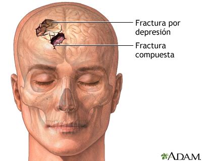 Fractura de cráneo