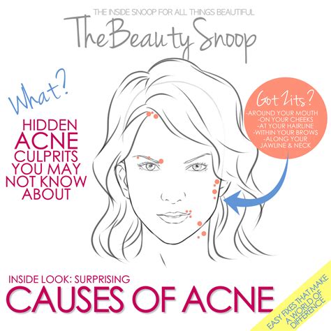 THE BEAUTY SNOOP: SURPRISING CAUSES OF ACNE- AND THE EASY FIXES YOU NEED TO KNOW ABOUT