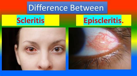 Episcleritis Vs Scleritis