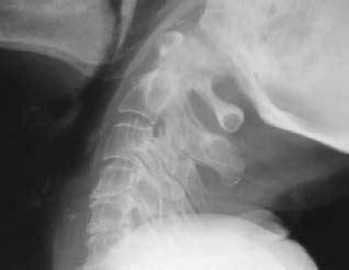 103 Atlantoaxial Instability | Radiology Key