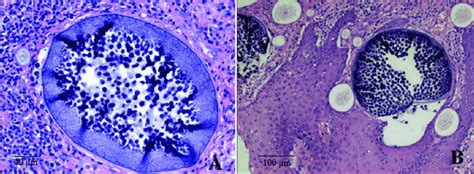 Histopathological exam characterized by the presence of sporangia (A ...