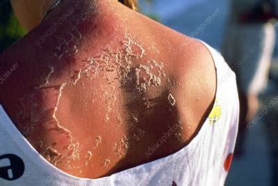Peeling skin on back of sunburnt woman - Stock Image - M335/0096 - Science Photo Library