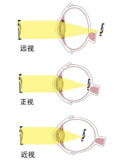 开学季健康宝典|预防近视，要看孩子“远视储备”还剩多少 - 新华网客户端