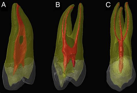 Root and Root Canal Morphology of Maxillary First Premolars: A Literature Review and Clinical ...