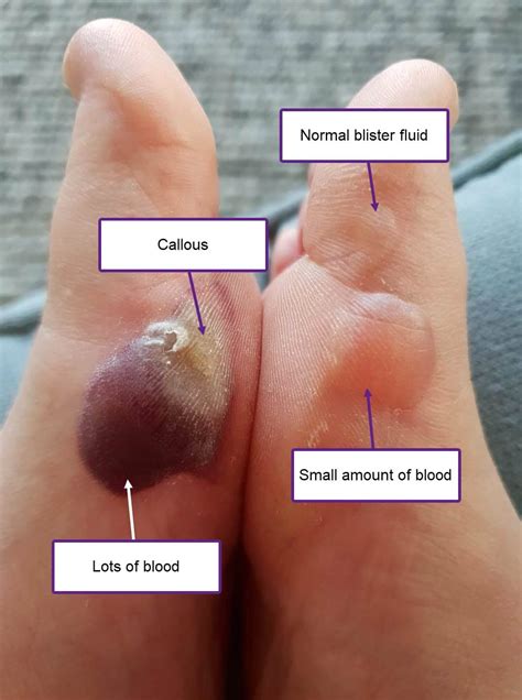 Blister Fluid Colours: What's Inside Your Blister? - Blister Prevention