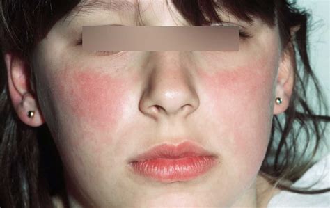 Fifth disease causes, incubation period, rash and fifth disease treatment