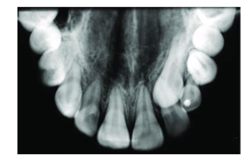 14 Upper standard occlusal radiograph | Download Scientific Diagram