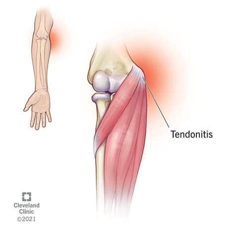 Golfer’s Elbow (Medial Epicondylitis): What Is It, Diagnosis & Treatment