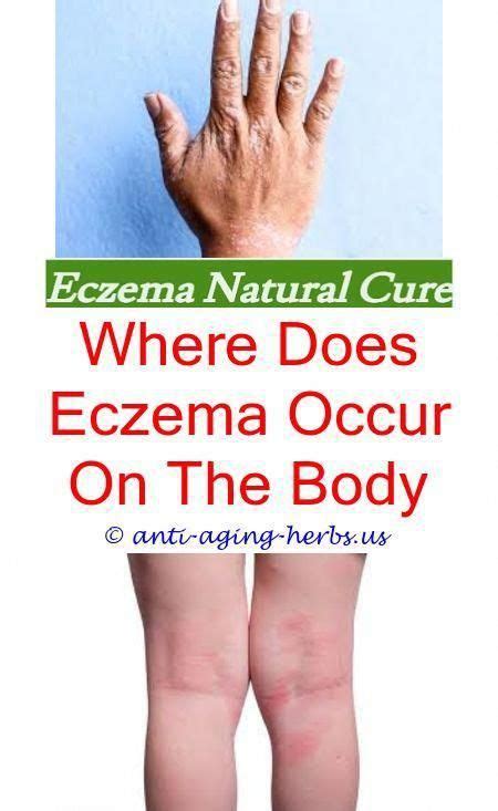 Vitamin D Eczema Baby