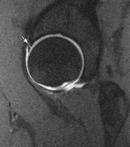 Hip Labral Tear - Knee & Sports - Orthobullets