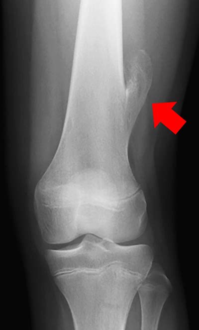 Deposition of aluminum and iron in benign bone tumors (exostosis) | Atlas of Science