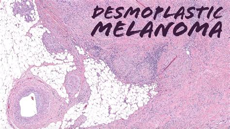 Desmoplastic Melanoma with Immunohistochemistry (UNC Case 1) dermpath dermatology pathology ...