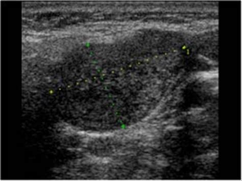 Head and Neck | 4.3 Salivary glands : Case 4.3.4 Warthin's tumors | Ultrasound Cases